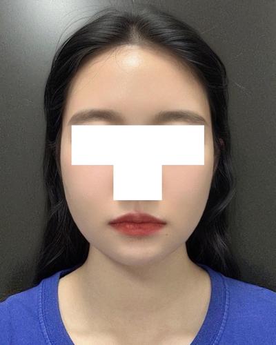 안면윤곽＋이중턱 지방흡입 5주차, 이중턱 진짜 없어졌어요 — 아바성형외과 환자 후기 사진