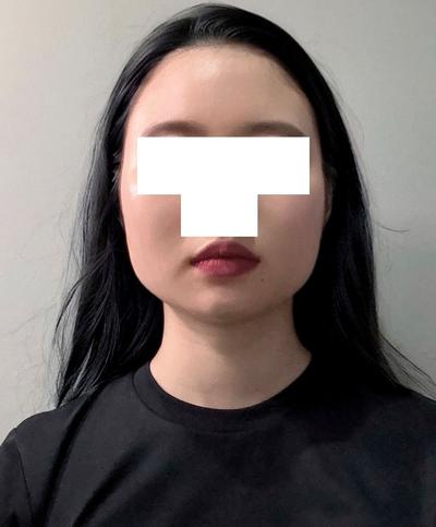 안면윤곽＋이중턱 지방흡입 5주차, 이중턱 진짜 없어졌어요 사진 2 — 아바성형외과 이중턱·윤곽 후기