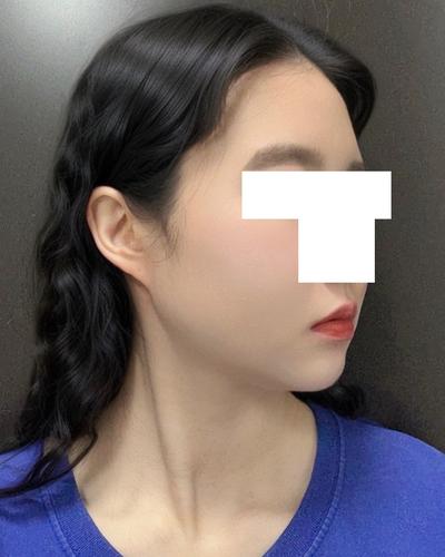 안면윤곽＋이중턱 지방흡입 5주차, 이중턱 진짜 없어졌어요 사진 5 — 아바성형외과 이중턱·윤곽 후기