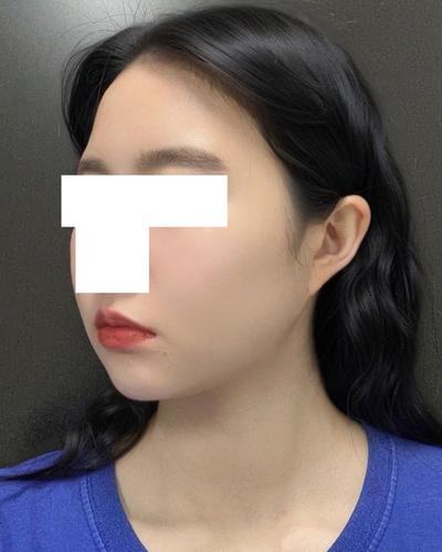 안면윤곽＋이중턱 지방흡입 5주차, 이중턱 진짜 없어졌어요 사진 6 — 아바성형외과 이중턱·윤곽 후기