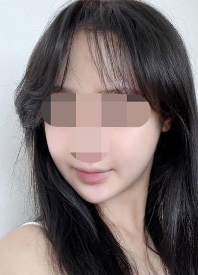 9주차 후기, 볼 붓기 빠지면서 라인 살아나는 중이에요 — 아바성형외과 환자 후기 사진