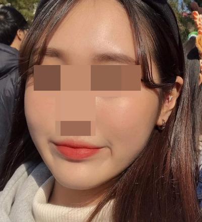 9주차 후기, 볼 붓기 빠지면서 라인 살아나는 중이에요 사진 2 — 아바성형외과 기타 후기