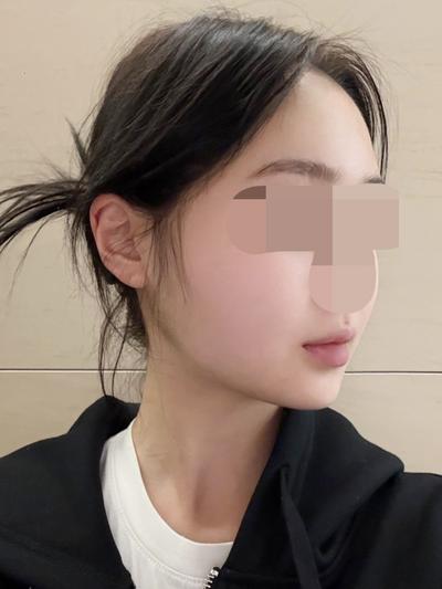 9주차 후기, 볼 붓기 빠지면서 라인 살아나는 중이에요 사진 4 — 아바성형외과 기타 후기