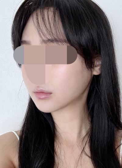 9주차 후기, 볼 붓기 빠지면서 라인 살아나는 중이에요 사진 5 — 아바성형외과 기타 후기