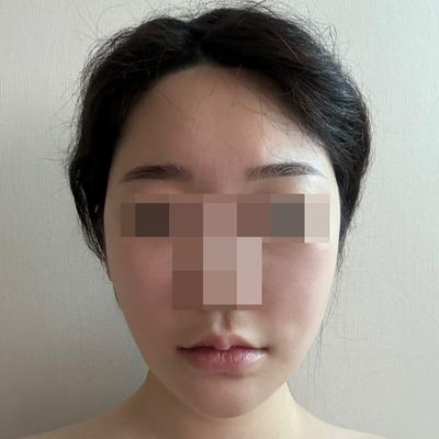 안면거상 9주차, 흉터도 거의 사라지고 제일 만족한 수술 — 아바성형외과 환자 후기 사진