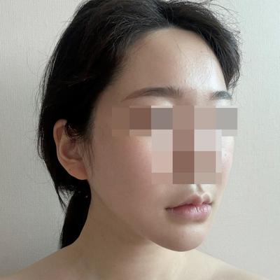 안면거상 9주차, 흉터도 거의 사라지고 제일 만족한 수술 사진 5 — 아바성형외과 안면거상 후기