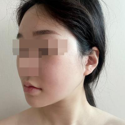안면거상 9주차, 흉터도 거의 사라지고 제일 만족한 수술 사진 6 — 아바성형외과 안면거상 후기