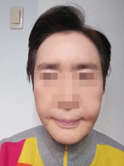 안면거상 환자 후기 — 브라운성형외과에서 이마거상이... (399)
