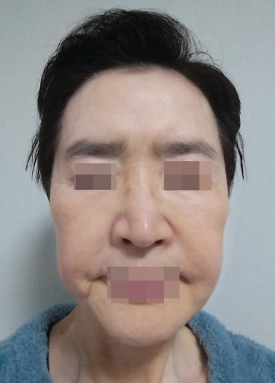 이마거상·아큐스컬프 5주차, 눈 뜨는 게 진짜 편해졌어요 사진 2 — 아바성형외과 안면거상 후기