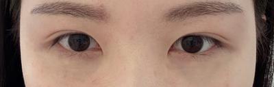 눈성형 환자 후기 — 병원에서 상담할때 자세하게 ... (4)