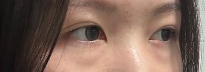눈밑지방재배치 2주차, 피곤해 보이는 인상 완전 없어졌어요 사진 2 — 아바성형외과 눈밑지방재배치 후기