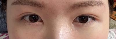눈밑지방재배치 2주차, 피곤해 보이는 인상 완전 없어졌어요 사진 4 — 아바성형외과 눈밑지방재배치 후기