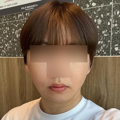 안면거상＋광대축소 9주차, 처짐 걱정 덜었어요 — 아바성형외과 환자 후기 사진