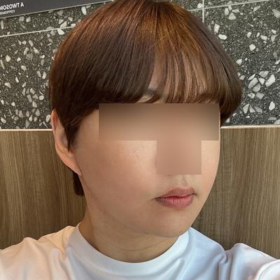 안면거상＋광대축소 9주차, 처짐 걱정 덜었어요 사진 5 — 아바성형외과 안면거상 후기