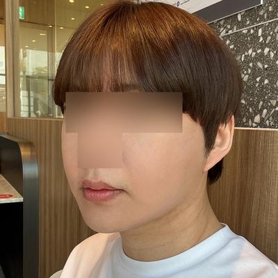 안면거상＋광대축소 9주차, 처짐 걱정 덜었어요 사진 6 — 아바성형외과 안면거상 후기