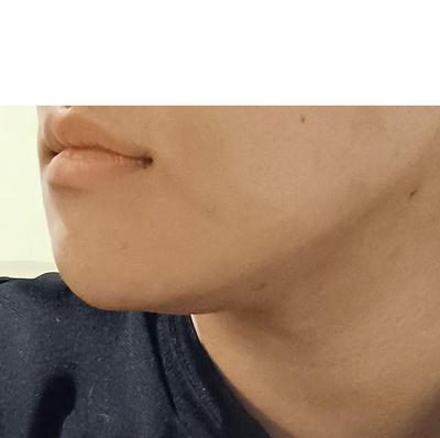 이중턱 근육묶기·아큐 지흡 후기, 턱선이 확 또렷해졌어요 — 아바성형외과 환자 후기 사진