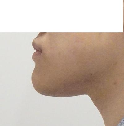 이중턱 근육묶기·아큐 지흡 후기, 턱선이 확 또렷해졌어요 사진 2 — 아바성형외과 이중턱·윤곽 후기