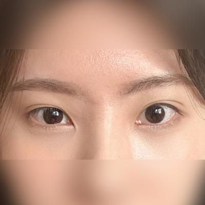 눈 수술 후 복시 불편감, 회복되면서 더 자연스러워졌어요 — 아바성형외과 환자 후기 사진