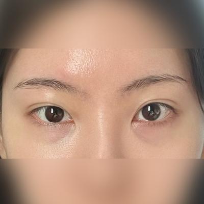 눈 수술 후 복시 불편감, 회복되면서 더 자연스러워졌어요 사진 2 — 아바성형외과 쌍꺼풀·눈성형 후기