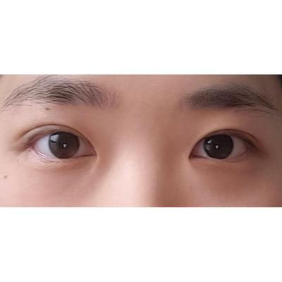 안검하수 눈매교정 8주차, 눈 뜨는 게 진짜 편해졌어요 — 아바성형외과 환자 후기 사진
