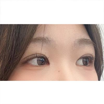 절개 쌍꺼풀 6주차, 눈 또렷해졌다는 말 자주 들어요 — 아바성형외과 환자 후기 사진