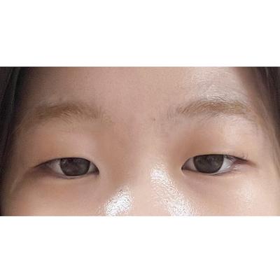 절개 쌍꺼풀 6주차, 눈 또렷해졌다는 말 자주 들어요 사진 3 — 아바성형외과 쌍꺼풀·눈성형 후기
