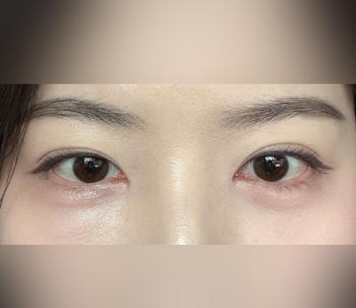 눈밑지방재배치 2주차, 화장하면 아무도 수술한 줄 몰라요 — 아바성형외과 환자 후기 사진