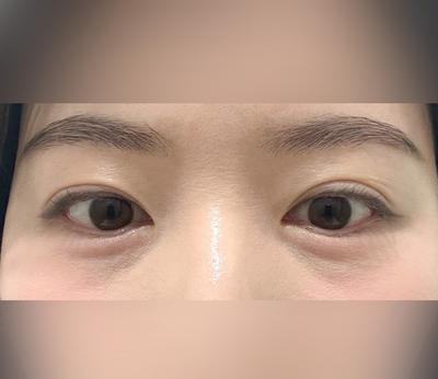 눈밑지방재배치 2주차, 화장하면 아무도 수술한 줄 몰라요 사진 2 — 아바성형외과 눈밑지방재배치 후기