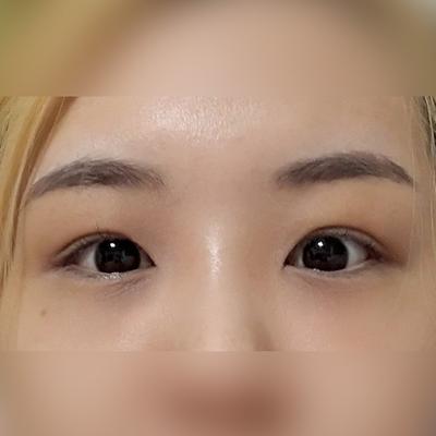 눈밑지방재배치 2주차, 화장 연하게 해도 될 정도예요 — 아바성형외과 환자 후기 사진