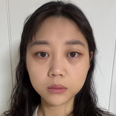 시술 10주차, 수술했었나 싶을 정도로 자연스러워요 사진 3 — 아바성형외과 쌍꺼풀·눈성형 후기