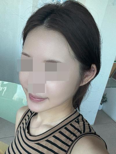 아큐거상 9주차, 윤곽 3종 같이 했는데 하길 진짜 잘했어요 — 아바성형외과 환자 후기 사진