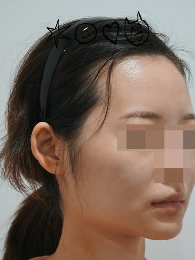 아큐거상 9주차, 윤곽 3종 같이 했는데 하길 진짜 잘했어요 사진 2 — 아바성형외과 안면거상 후기