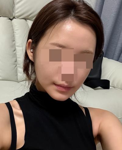 아큐거상 9주차, 윤곽 3종 같이 했는데 하길 진짜 잘했어요 사진 4 — 아바성형외과 안면거상 후기