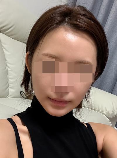 아큐거상 9주차, 윤곽 3종 같이 했는데 하길 진짜 잘했어요 사진 5 — 아바성형외과 안면거상 후기