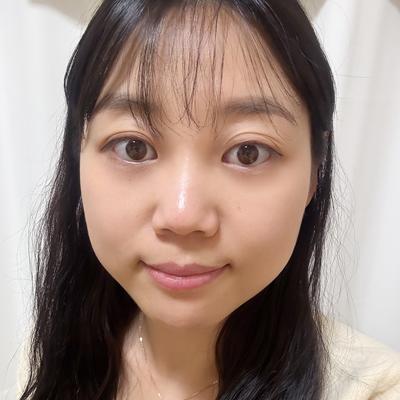 눈밑지방재배치 8주차, 다크서클 고민 덜어서 하길 잘했어요 사진 4 — 아바성형외과 눈밑지방재배치 후기
