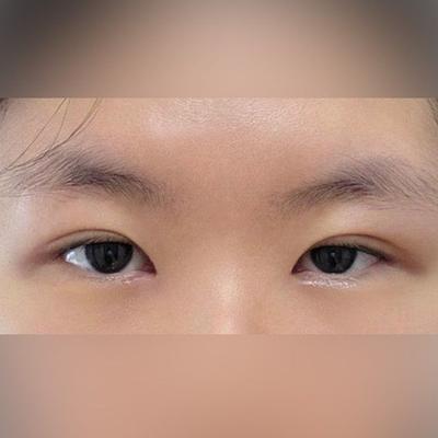 부분절개 쌍꺼풀＋윗트임 8주차, 인위적이지 않고 딱 원한 라인 — 아바성형외과 환자 후기 사진