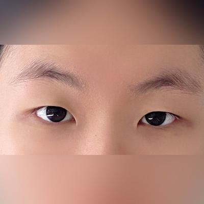 부분절개 쌍꺼풀＋윗트임 8주차, 인위적이지 않고 딱 원한 라인 사진 2 — 아바성형외과 쌍꺼풀·눈성형 후기