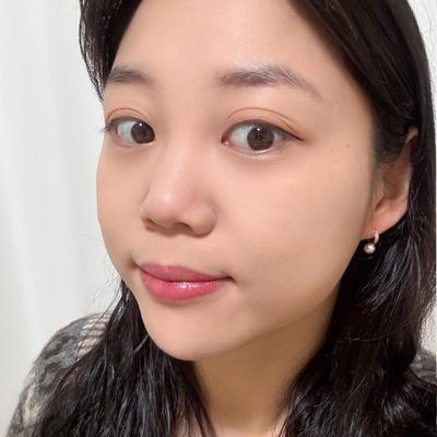 수술 6주차, 이제 완전 자연스럽게 자리잡아서 만족해요 — 아바성형외과 환자 후기 사진