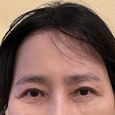 수면마취 수술 4주차, 붓기 빠지는 중인데 맘에 들어요 — 아바성형외과 환자 후기 사진