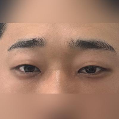 눈밑지방재배치 중안면거상 6주차, 인상 밝아졌다는 말 진짜 많이 들어요 — 아바성형외과 환자 후기 사진