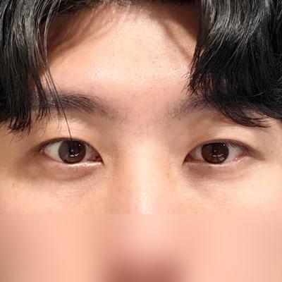 눈성형 환자 후기 — 브라운성형외과 김승수원장님 ... (419)