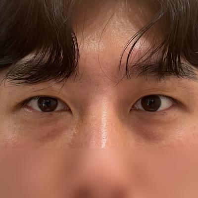 눈밑지방재배치 4주차, 한 달 되니 훨씬 자연스러워졌어요 사진 2 — 아바성형외과 눈밑지방재배치 후기