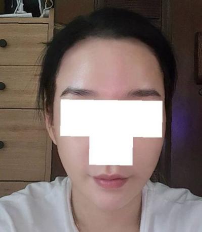 쁘띠시술 환자 후기 — 내 나이 50대에서 30대로... (42)