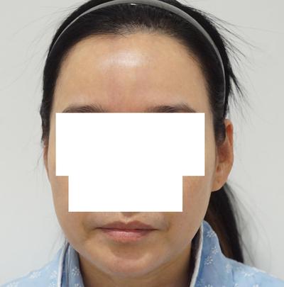 입술필러·미간보톡스 후기, 50대가 30대로 보인다네요 사진 2 — 아바성형외과 리프팅·쁘띠 후기