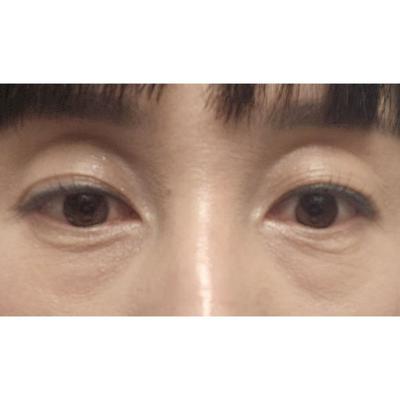 아바성형외과 수술 2주차, 회복 보니 진짜 잘했다 싶어요 사진 2 — 아바성형외과 기타 후기