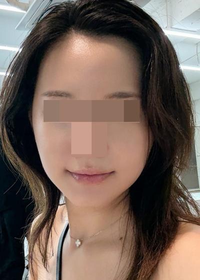 안면윤곽 3종＋아큐거상 3주차, 붓기 적어 일 다 했어요 — 아바성형외과 환자 후기 사진