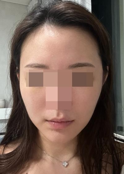 안면윤곽 3종＋아큐거상 3주차, 붓기 적어 일 다 했어요 사진 2 — 아바성형외과 안면거상 후기