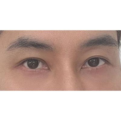 하안검 8주차, 디테일한 맞춤 상담 듣고 바로 결심했어요 — 아바성형외과 환자 후기 사진