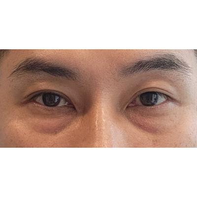 하안검 8주차, 디테일한 맞춤 상담 듣고 바로 결심했어요 사진 2 — 아바성형외과 하안검 후기