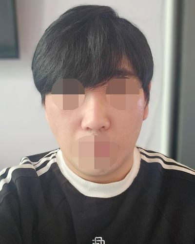 스마스거상에 티타늄 리프팅까지, 관리 만족도 진짜 커요 — 아바성형외과 환자 후기 사진